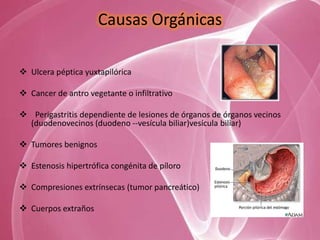 Causas Orgánicas

 Ulcera péptica yuxtapilórica

 Cancer de antro vegetante o infiltrativo

 Perigastritis dependiente de lesiones de órganos de órganos vecinos
  (duodenovecinos (duodeno --vesícula biliar)vesícula biliar)

 Tumores benignos

 Estenosis hipertrófica congénita de píloro

 Compresiones extrínsecas (tumor pancreático)

 Cuerpos extraños
 
