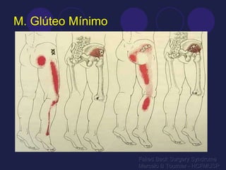 M. Glúteo Mínimo Failed Back Surgery Syndrome Marcelo B Tournier - HCFMUSP 