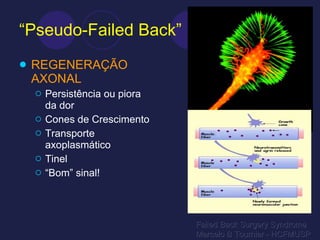 “ Pseudo-Failed Back” REGENERAÇÃO AXONAL Persistência ou piora da dor Cones de Crescimento Transporte axoplasmático Tinel “ Bom” sinal! Failed Back Surgery Syndrome Marcelo B Tournier - HCFMUSP 
