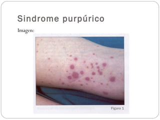 Sindrome purpúrico
Imagen:
 