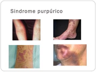 Sindrome purpúrico
 