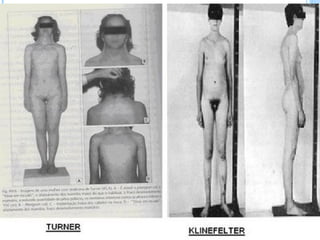 Sindromes cromosomicos
