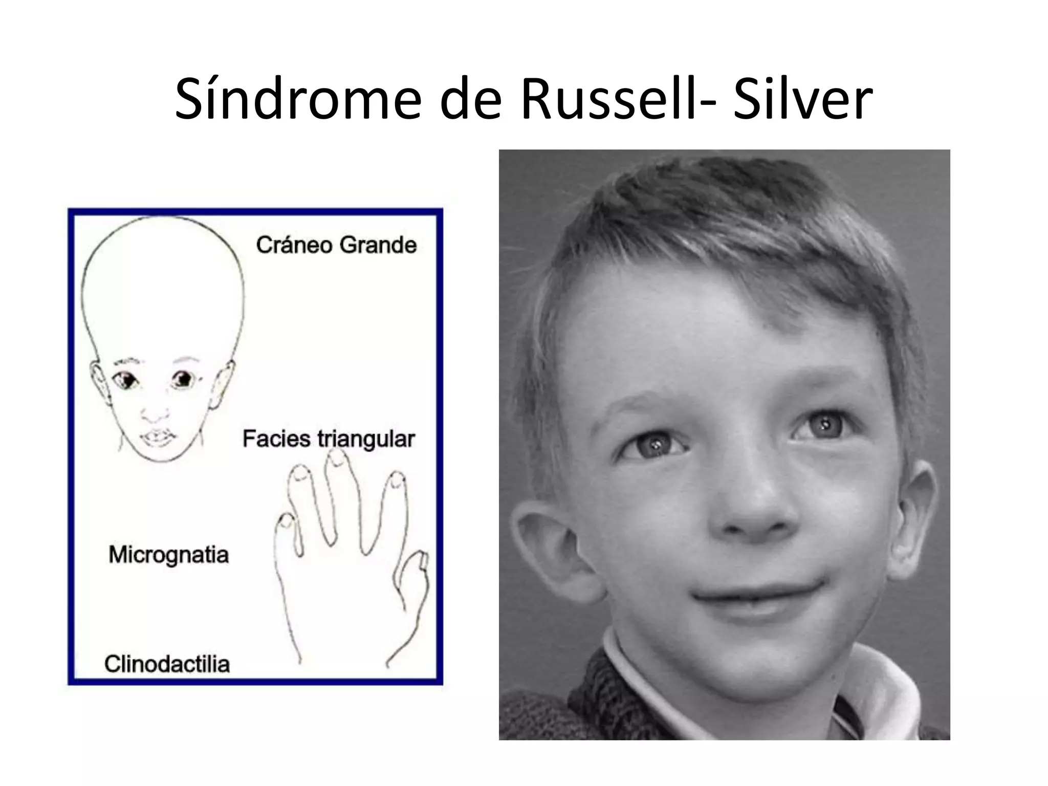 sindrome di silver russell immagini