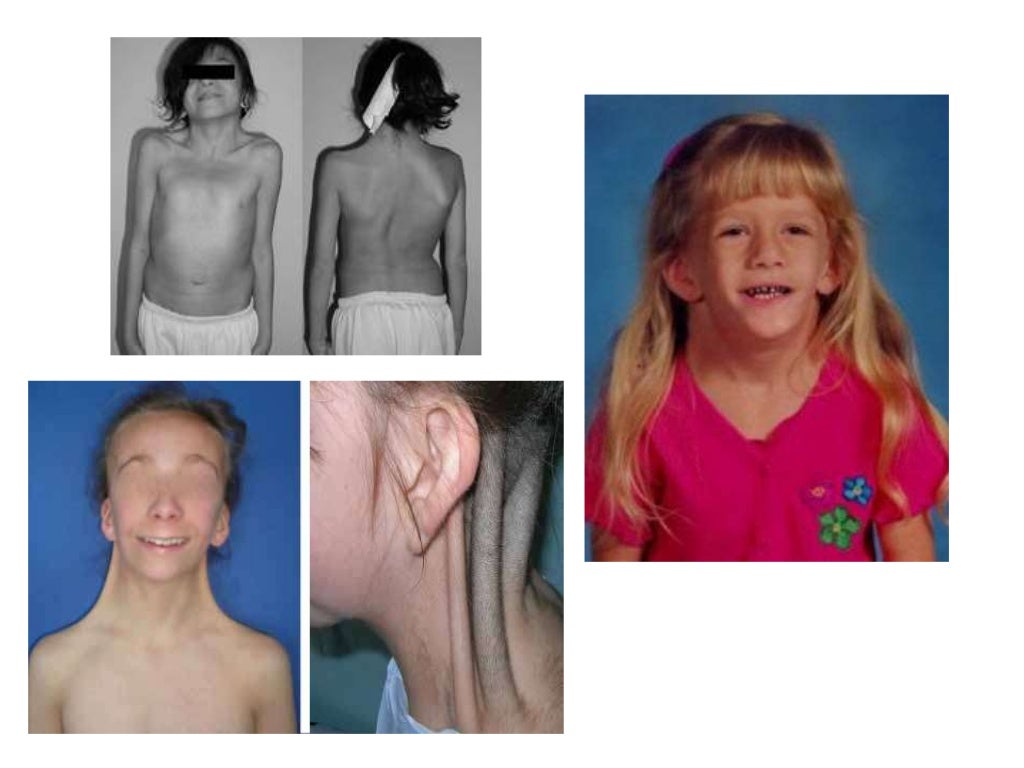 Sindrome de Down, Patau, Edwards, Klinefelter, Turner, PraderWilli y…