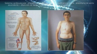 Sistema cardiovascular : prolapso de la valvula mitral > insuficiencia mitral , aneurisma de aorta
ascendente > diseccion de aorta > insuficiencia cardiaca congestiva
 