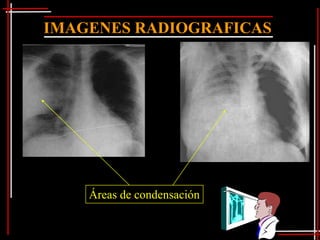 IMAGENES RADIOGRAFICAS




    Áreas de condensación
 