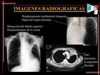 IMAGENES RADIOGRAFICAS
            Desplazamiento mediastinal (traquea)
            Signo del raquis desnudo

Retracción del lóbulo superior
Desplazamiento de la cisura




                                                   TAC:
                                                   determina
                                                   el segmento
                                                   afectado
 