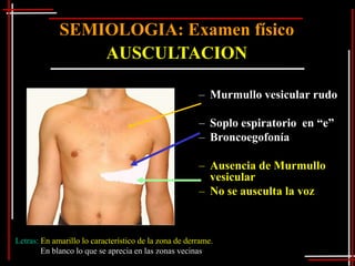 SEMIOLOGIA: Examen físico
                 AUSCULTACION

                                                       – Murmullo vesicular rudo

                                                       – Soplo espiratorio en “e”
                                                       – Broncoegofonía

                                                       – Ausencia de Murmullo
                                                         vesicular
                                                       – No se ausculta la voz



Letras: En amarillo lo característico de la zona de derrame.
        En blanco lo que se aprecia en las zonas vecinas
 