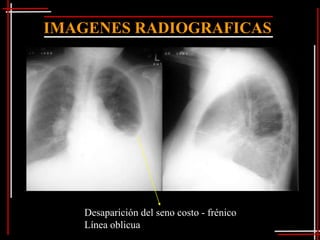 IMAGENES RADIOGRAFICAS




   Desaparición del seno costo - frénico
   Línea oblicua
 