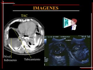 IMAGENES
             TAC




Nivel
hidroaereo    Tabicamiento
 