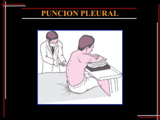 PUNCION PLEURAL
 