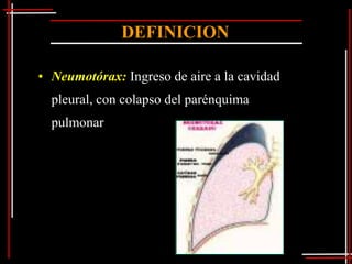 DEFINICION

• Neumotórax: Ingreso de aire a la cavidad
  pleural, con colapso del parénquima
  pulmonar
 