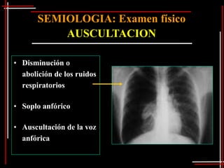 SEMIOLOGIA: Examen físico
           AUSCULTACION

• Disminución o
  abolición de los ruidos
  respiratorios

• Soplo anfórico

• Auscultación de la voz
  anfórica
 