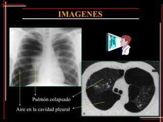 IMAGENES




       Pulmón colapsado
Aire en la cavidad pleural
 