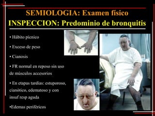 SEMIOLOGIA: Examen físico
INSPECCION: Predominio de bronquitis
• Hábito pícnico

• Exceso de peso

• Cianosis

• FR normal en reposo sin uso
de músculos accesorios

• En etapas tardías: estuporoso,
cianótico, edematoso y con
insuf resp aguda

•Edemas periféricos
 