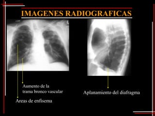 IMAGENES RADIOGRAFICAS




   Aumento de la
   trama bronco vascular   Aplanamiento del diafragma
Areas de enfisema
 