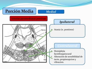 Medial
Ipsilateral
Arterias paramedianas pontinas
• Hemiplejia
faciobraquiocural
• Alteración de sensibilidad de
tacto, propiocepcion y
vibracion.
Contralateral
• Ataxia (n. pontinos)
 