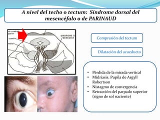 A nivel del techo o tectum: Síndrome dorsal del
mesencéfalo o de PARINAUD
• Pérdida de la mirada vertical
• Midriasis. Pupila de Argyll
Robertson
• Nistagmo de convergencia
• Retracción del parpado superior
(signo de sol naciente)
Compresión del tectum
Dilatación del acueducto
 