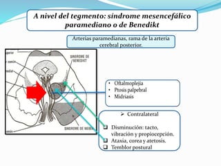 A nivel del tegmento: síndrome mesencefálico
paramediano o de Benedikt
 Contralateral
 Disminución: tacto,
vibración y propiocepción.
 Ataxia, corea y atetosis.
 Temblor postural
Arterias paramedianas, rama de la arteria
cerebral posterior.
 