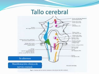 Tallo cerebral
Sx alternos
Manifestación clínica de
nervio craneal.
 