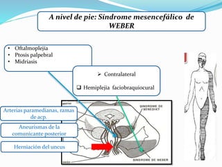 A nivel de pie: Síndrome mesencefálico de
WEBER
• Oftalmoplejía
• Ptosis palpebral
• Midriasis
 Contralateral
 Hemiplejia faciobraquiocural
Arterias paramedianas, ramas
de acp.
Aneurismas de la
comunicante posterior
Herniación del uncus
 