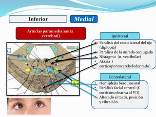 Inferior Medial
Ipsilateral
Contralateral
• Parálisis del recto lateral del ojo
(diplopía)
• Parálisis de la mirada conjugada
• Nistagmo (n. vestibular)
• Ataxia (
corticopontocerebelodentado)
• Hemiplejia braquiocural
• Parálisis facial central (f.
corticonuclear va al VII)
• Alterado el tacto, posición
y vibración.
Arterias paramedianas (a.
vertebral)
 