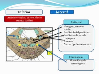 Inferior lateral
Ipsilateral
Contralateral
• Nistagmo, nauseas
vomito.
• Parálisis facial periférica.
• Parálisis de la mirada
conjugada.
• Anacusia
• Ataxia ( pedúnculo c.m.)
• Alteración de la
termoalgesia
Arteria cerebelosa anteroinferior
(tronco basilar)
 