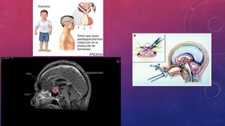 Sindromes de neoplasia endocrina  multiple (MEN)