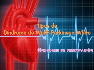 Tipos de Síndrome de Wolff-Parkinson-White Síndromes de preexitación 