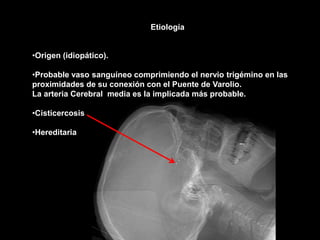 •Origen (idiopático).
•Probable vaso sanguíneo comprimiendo el nervio trigémino en las
proximidades de su conexión con el Puente de Varolio.
La arteria Cerebral media es la implicada más probable.
•Cisticercosis
•Hereditaria
Etiología
 