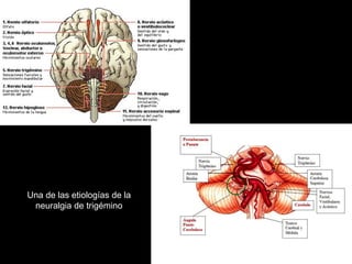 Una de las etiologías de la
neuralgia de trigémino
 