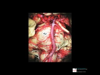 Revista chilena de anatomía
versión impresa ISSN 0716-9868
Rev. chil. anat. v.17 n.2 Temuco
 