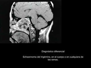 Diagnóstico diferencial
Schwannoma del trigémino, en el cuerpo o en cualquiera de
las ramas.
 