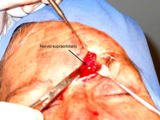 Nervio supraorbitario
 