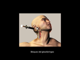Bloqueo del glosofaríngeo
 