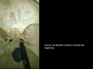 Cavum de Meckel, asiento craneal del
trigémino.
 
