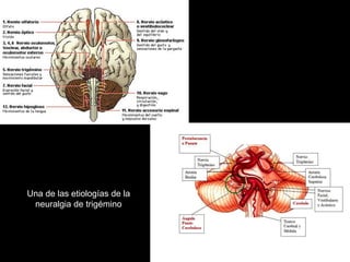 Una de las etiologías de la
neuralgia de trigémino
 