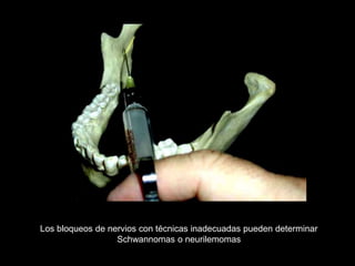 Los bloqueos de nervios con técnicas inadecuadas pueden determinar
Schwannomas o neurilemomas
 