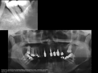 Schwannoma o Neurilemoma de la Mandíbula Carlos Guillermo Rodríguez Torres* * Odontólogo, Universidad
Javeriana, Santafé de Bogotá, Colombia; Centro de Radiodiagnóstico, Clínica Dental de la Universidad de
Viena, Austria.
 
