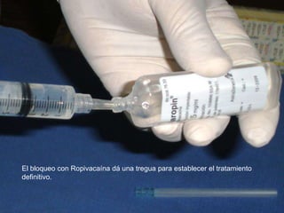 El bloqueo con Ropivacaína dá una tregua para establecer el tratamiento
definitivo.
 