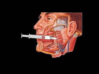 ración del VII par accidental al tratar de bloquear el dentario a la altura de la língula
 