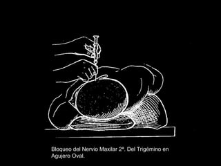 Bloqueo del Nervio Maxilar 2ª. Del Trigémino en
Agujero Oval.
 