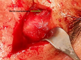Nervio supraorbitario
 
