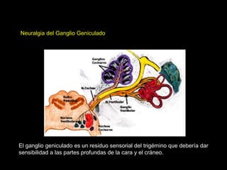 Neuralgia del Ganglio Geniculado
El ganglio geniculado es un residuo sensorial del trigémino que debería dar
sensibilidad a las partes profundas de la cara y el cráneo.
 