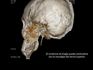 El síndrome de Eagle puede confundirse
con la neuralgia del nervio superior.
 
