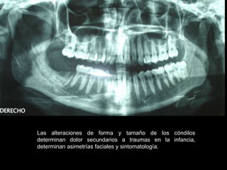 Las alteraciones de forma y tamaño de los cóndilos
determinan dolor secundarios a traumas en la infancia,
determinan asimetrías faciales y sintomatología.
 