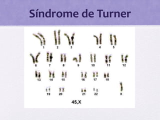 Síndrome de Turner
 