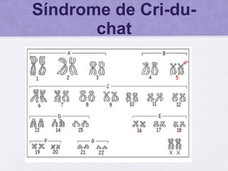 Síndrome de Cri-du-
chat
 