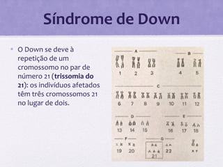 Síndrome de Down
• O Down se deve à
repetição de um
cromossomo no par de
número 21 (trissomia do
21): os indivíduos afetados
têm três cromossomos 21
no lugar de dois.
 