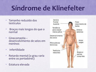 Síndrome de Klinefelter
• Tamanho reduzido dos
testículos
• Braços mais longos do que o
normal
• Ginecomastia –
desenvolvimento de seios em
meninos
• Infertilidade
• Retardo mental (o grau varia
entre os portadores)
• Estatura elevada
 
